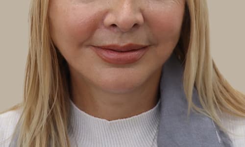 After dermal filler treatment showing restored facial volume and smoother contours