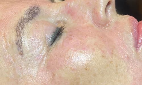After aesthetic treatment showing visibly rejuvenated and refreshed appearance