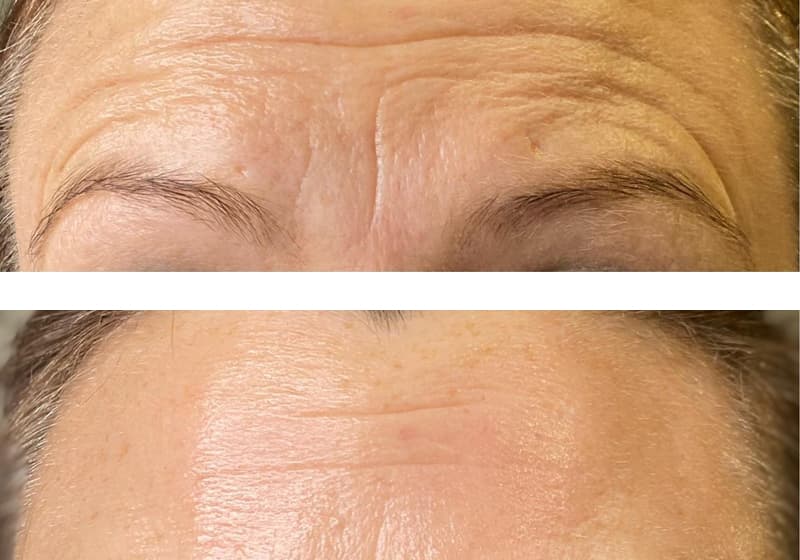 Botox