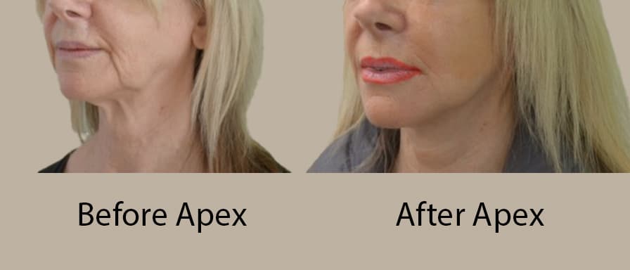 Apex Facelift support and recovery at Beyond The Face