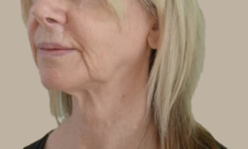 Before anti-wrinkle treatment showing forehead lines and crow's feet in Tunbridge Wells