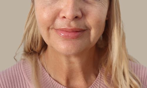 Before dermal filler treatment showing volume loss and nasolabial folds