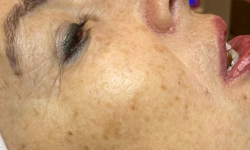 Before aesthetic treatment showing signs of ageing and skin concerns